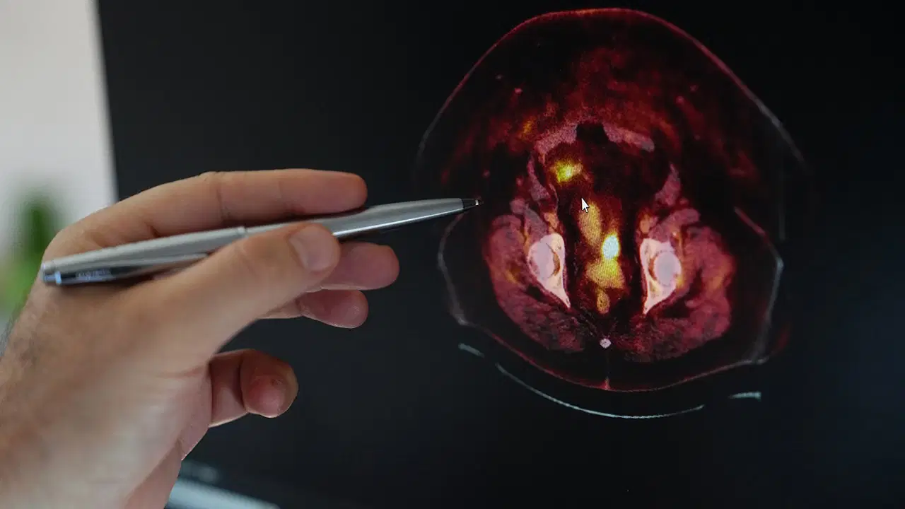 obezite endometrium kanseri riskini artiriyor R8y9iba3